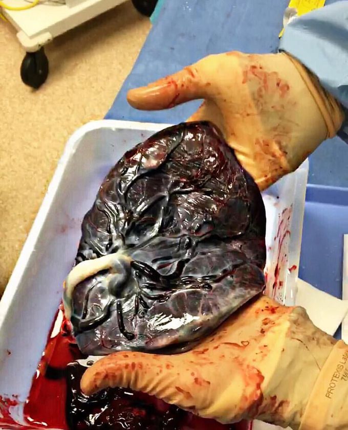 Placenta and the umbilical cord