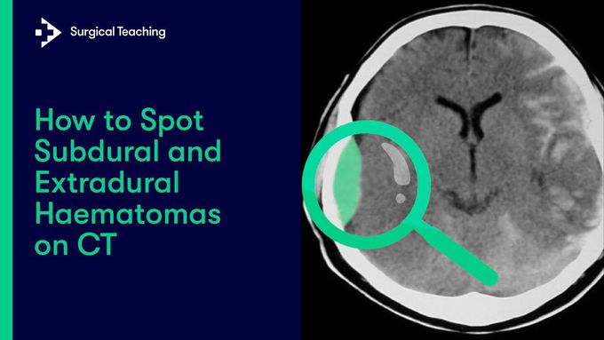 Extradural vs Subdural Haematomas | How do we Diagnose them on CT?