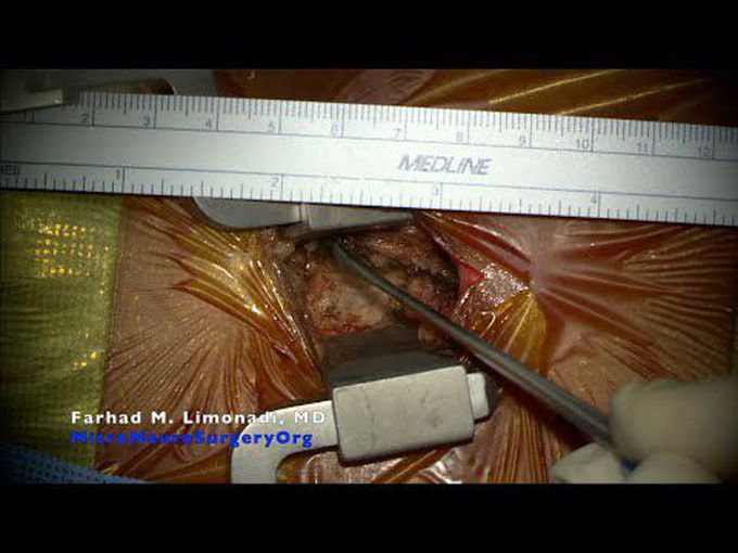 Microdiscectomy and removal of herniated disk causing radiculopathy.(Lumbar spine microsurgery).
