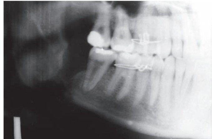 Chronic osteomyelitis