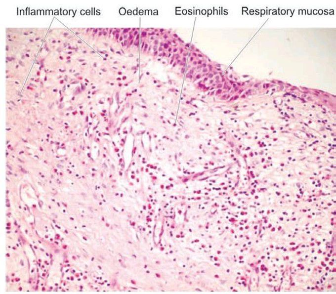 Allergic polyp nose.