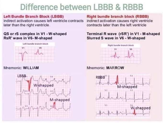 Left Bundle Branch Block and Right Bundle Branch Block