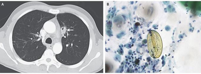Hemoptysis Associated with Paragonimus westermani