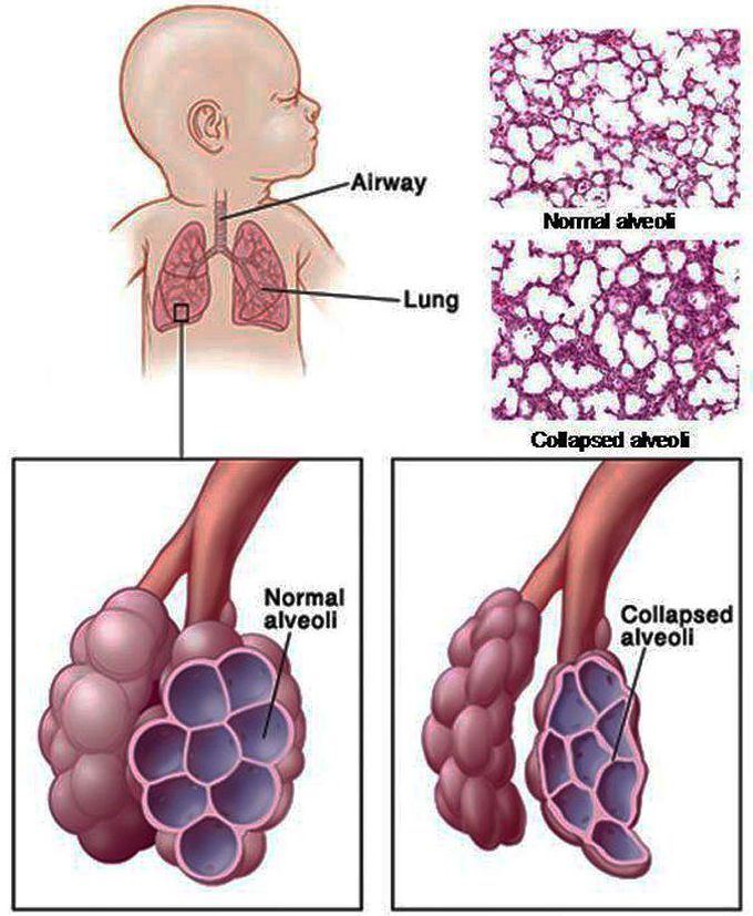 Neonatal Respiratory Distress Syndrome