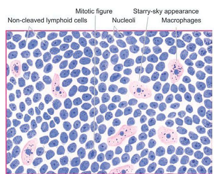 Burkitt’s lymphoma.