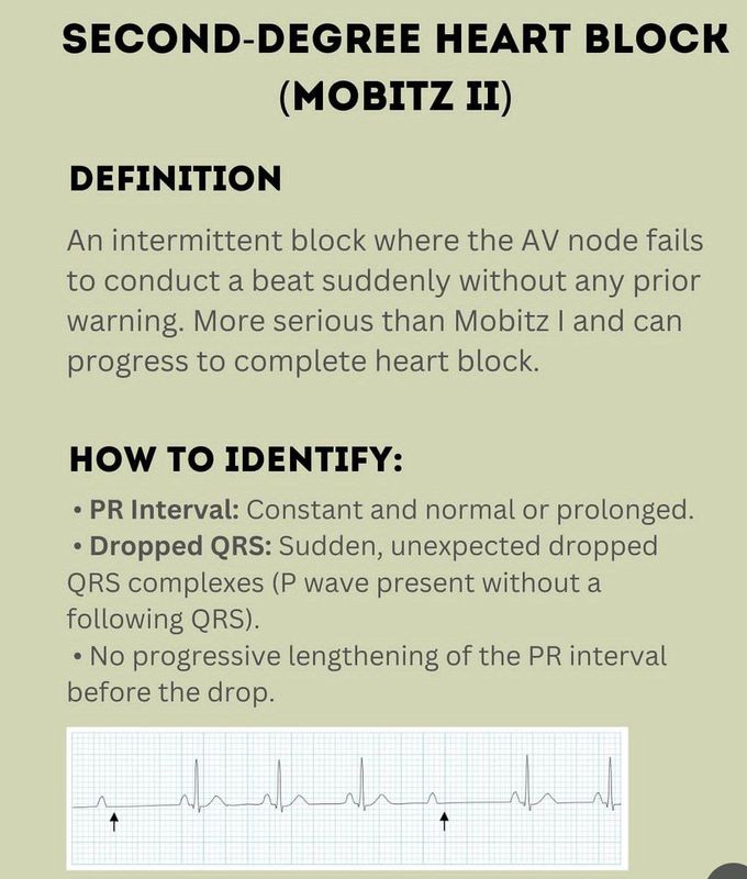 Second Degree Heart Block II