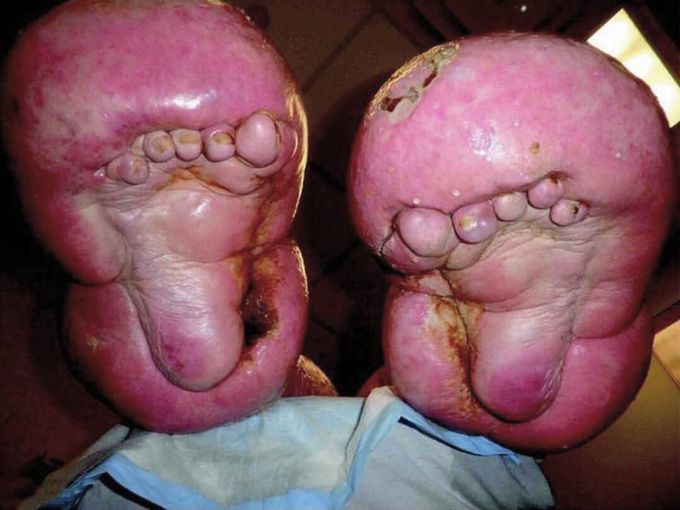 Extreme case of lymphedema! 