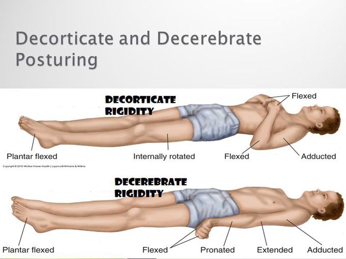 Decorticate and Decerebrate posturing