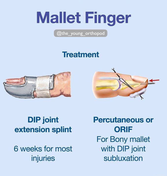 Mallet Finger IV