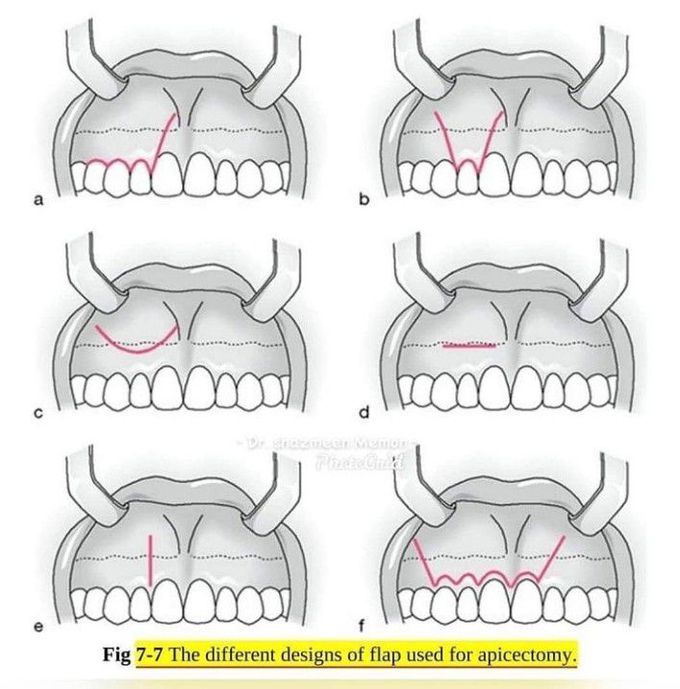 Different desgins of flaps used for apicectomy