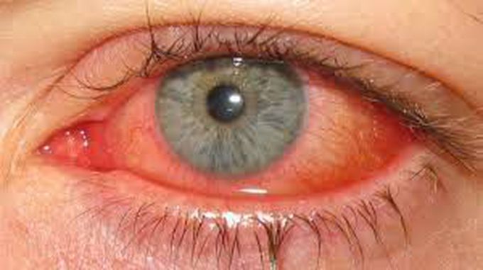 Keratoconjunctivitis Treatment