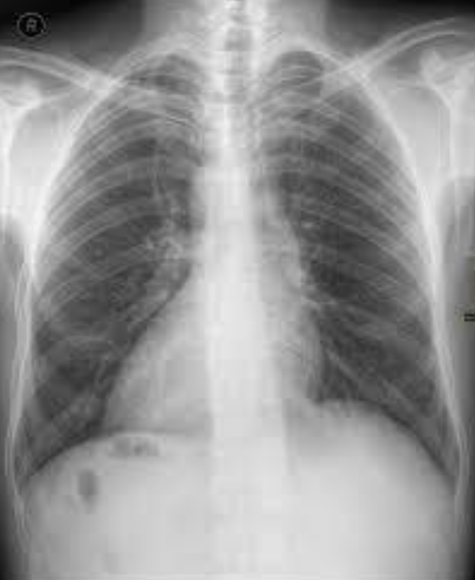 Chest Xray. AP view.