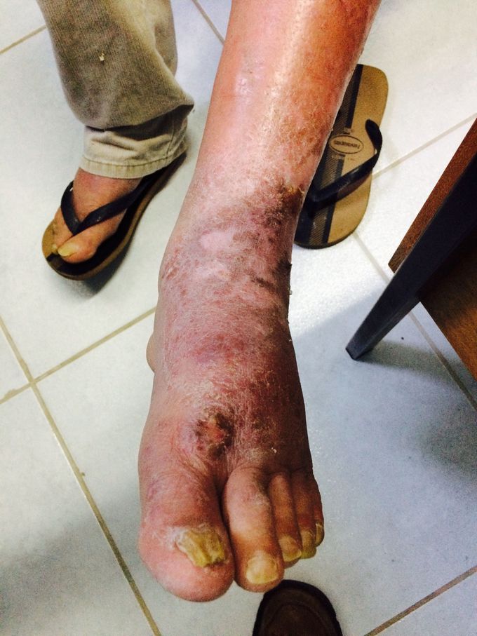 Edema the lower limbs