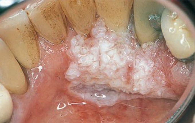 Verrucous carcinoma