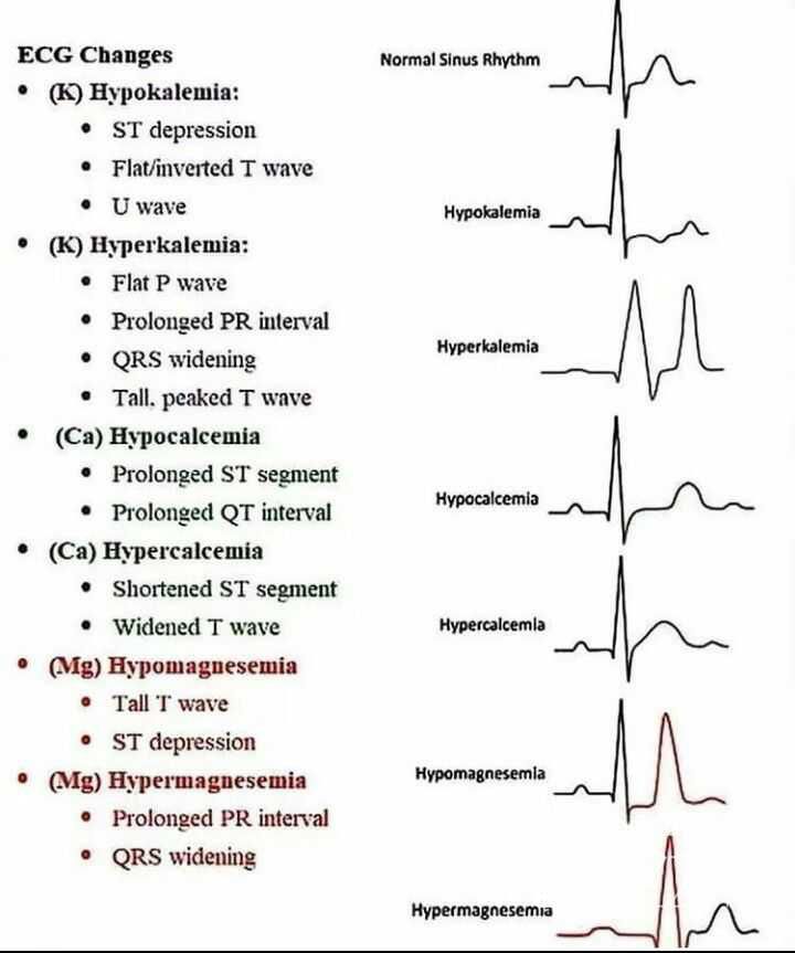 Snapshot Of Ecg Changes In Electrolytes Imbalance Medizzy