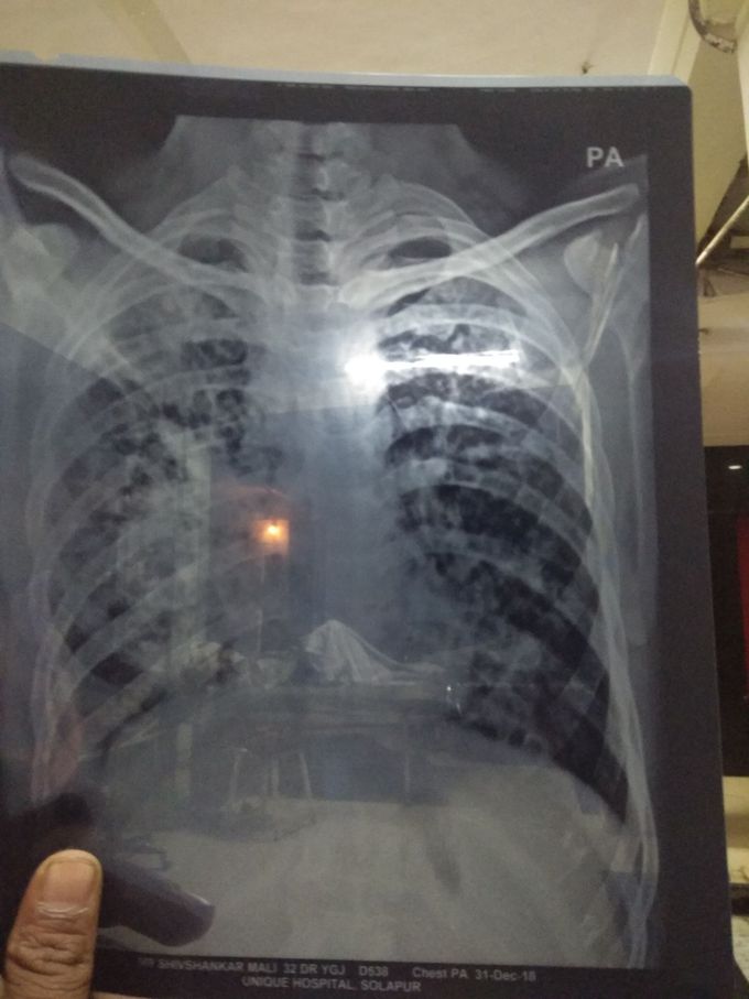 ? Tubercular etiology