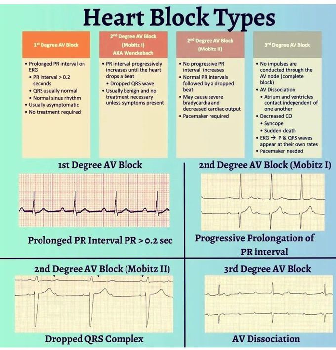 Heart Block Types
