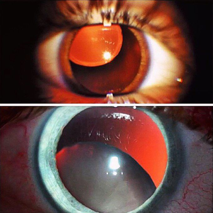 Upward vs. downward lens dislocations!
