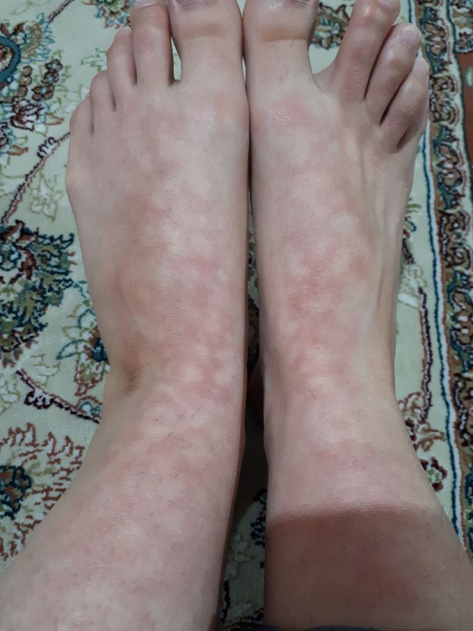 Diagnose this vascular disease please!