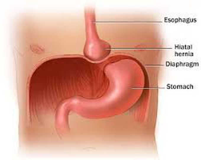 Hiatus Hernia and GERD