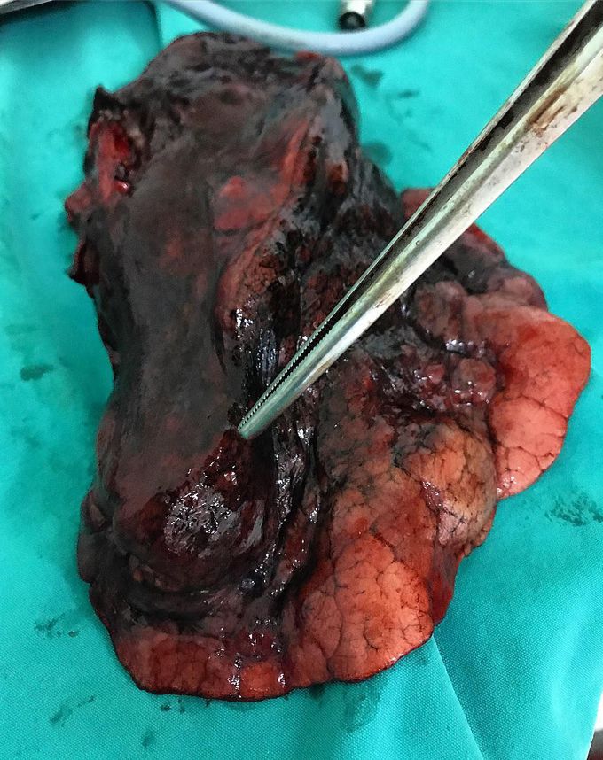 Non-small cell lung carcinoma lesion from a left lower lobectomy specimen!  