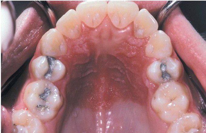 Hereditary Mucoepithelial Dysplasia