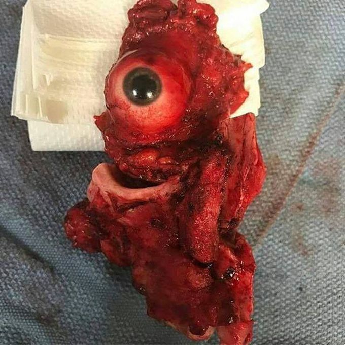 Orbitomaxillary resection