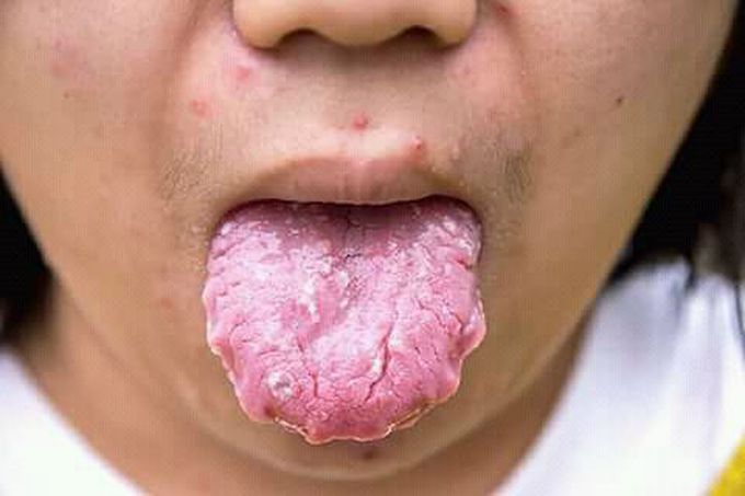 fungal oral infection,,,,