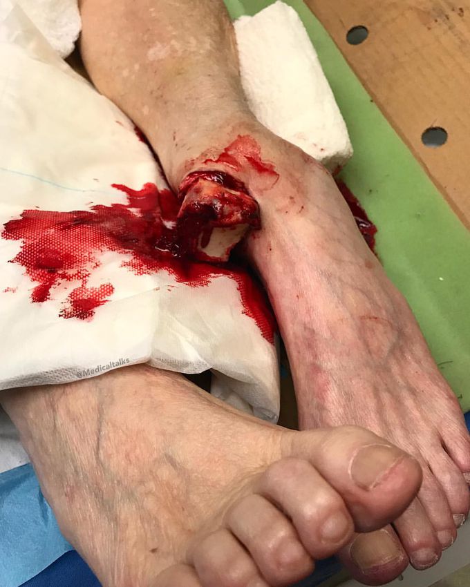 Compound open dislocation of ankle!! 