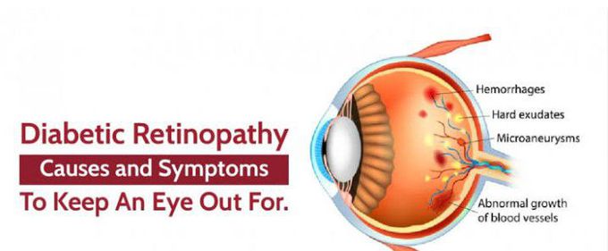 Cause of Diabetic retinopathy