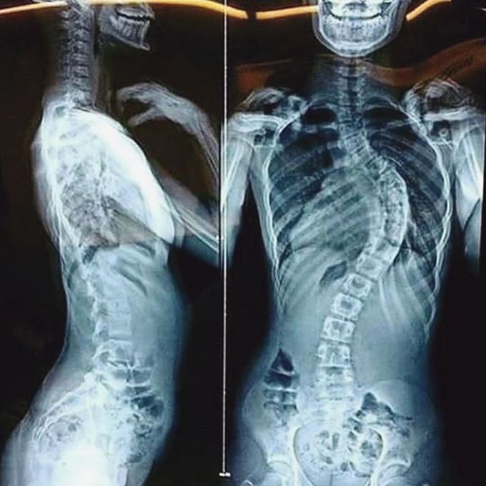 Scoliosis and dextrocardia
