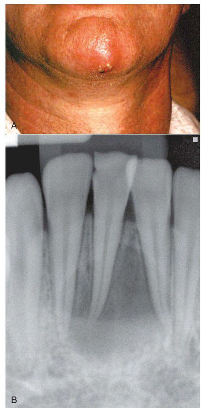 sinus tract