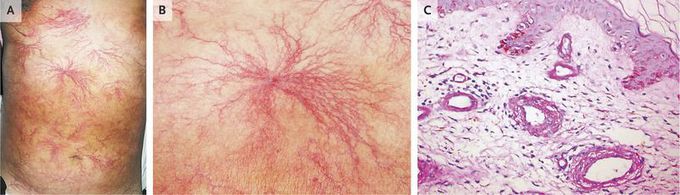 Cutaneous Collagenous Vasculopathy