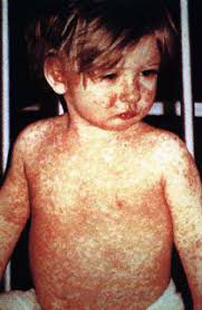 Symptoms of measles