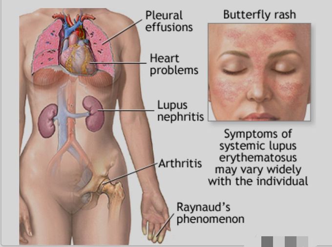 SLE (Systemic Lupus erythematous)