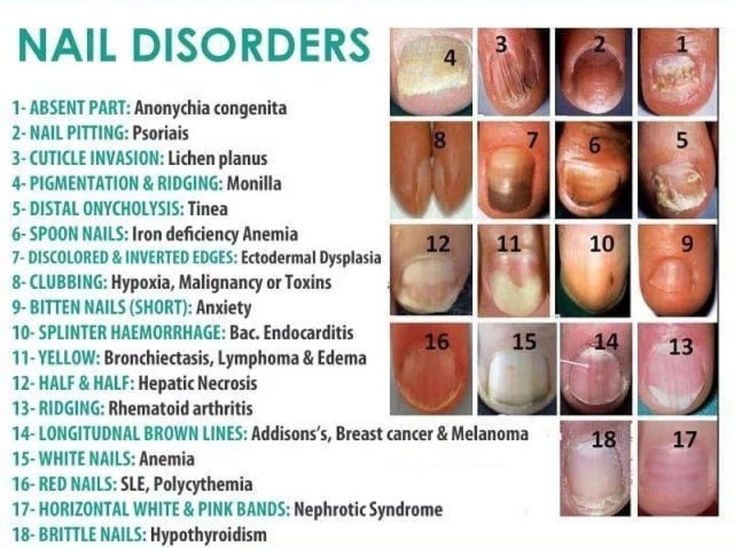 Nail Disorders Medizzy