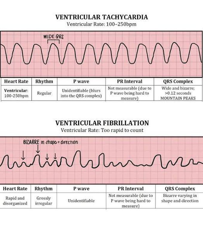 Ventricular tachycardia and Ventricular Fibrillation