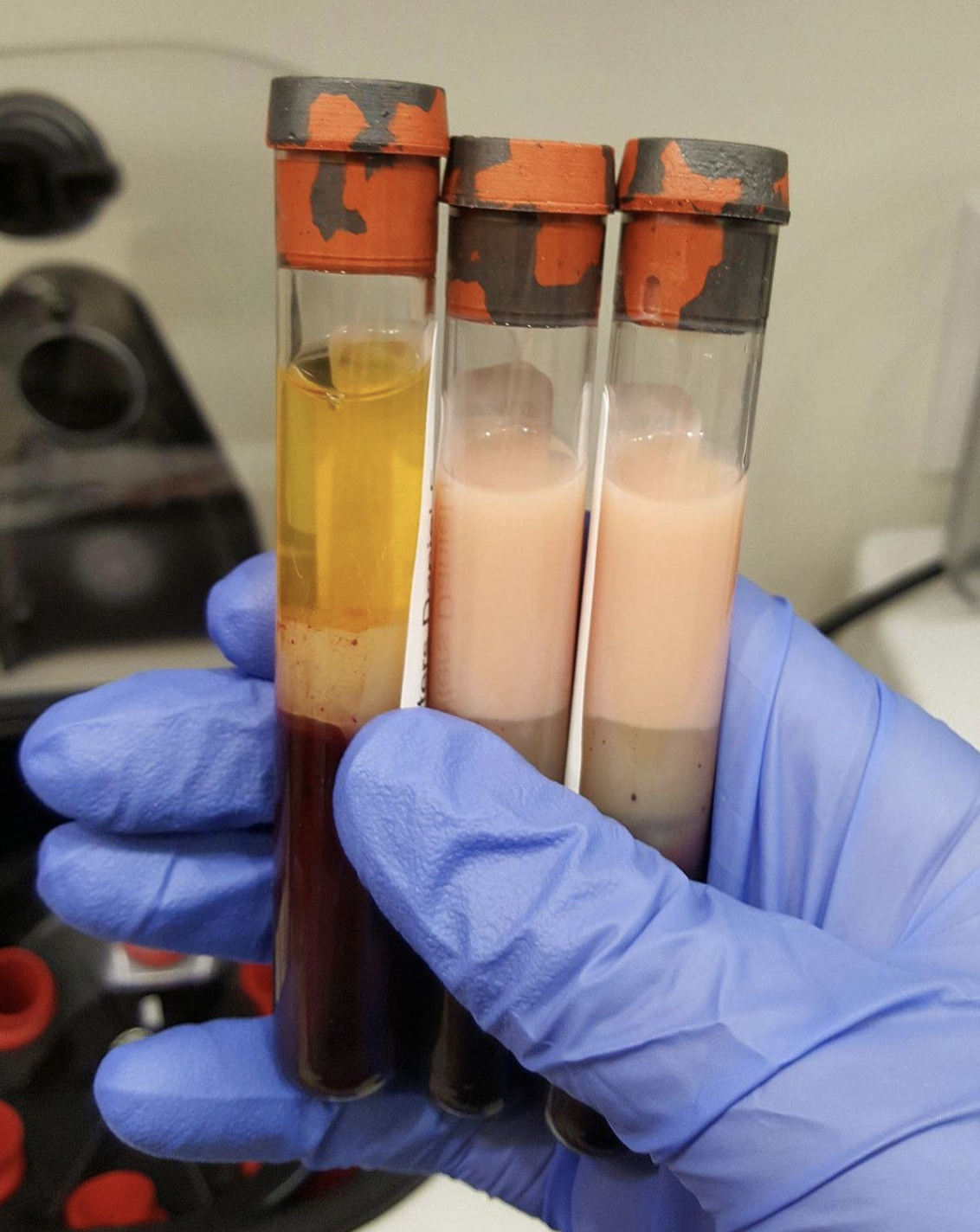 Normal Plasma left Sample And Lipemic Plasma right Two MEDizzy