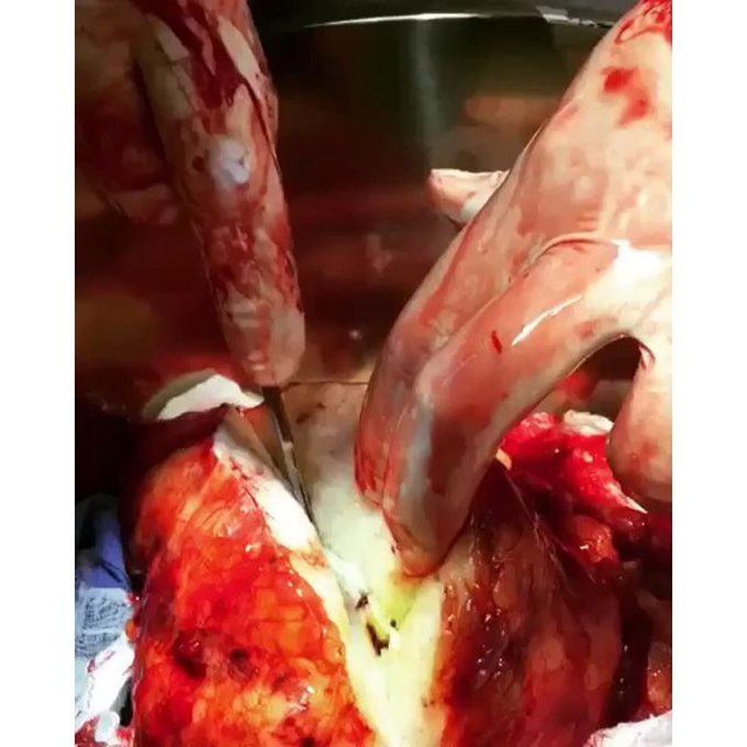 Cutting open very rare cancer the heart ♥️
