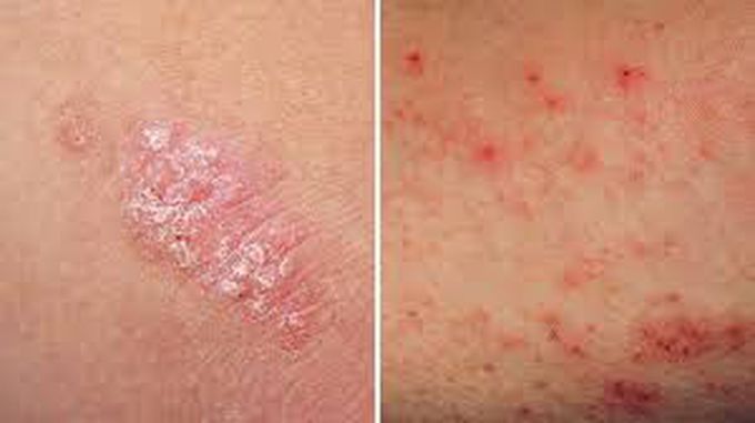 Causes of Psoriasis