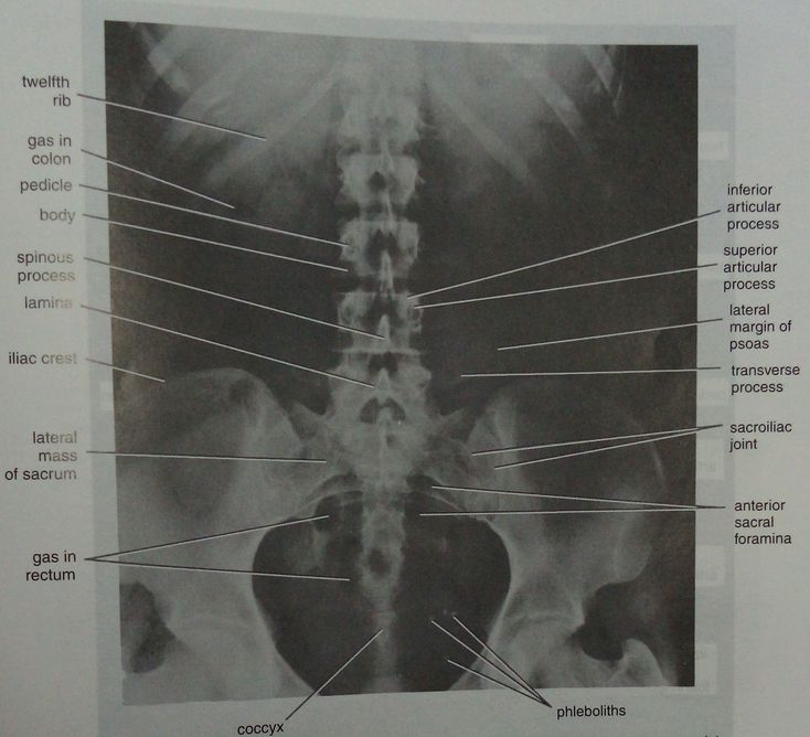 Ant-post radiograph of lower thoracic,lumbar&sacral regions - MEDizzy