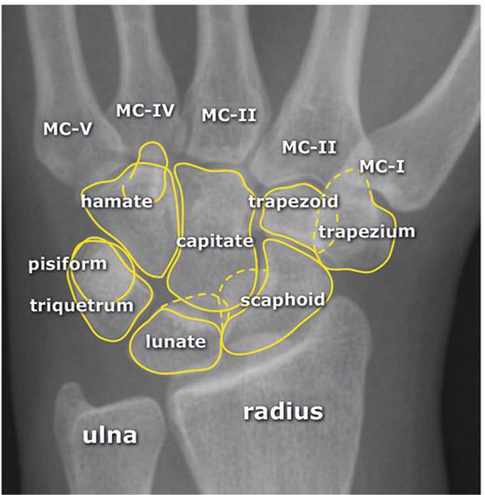 X-ray carpal bone