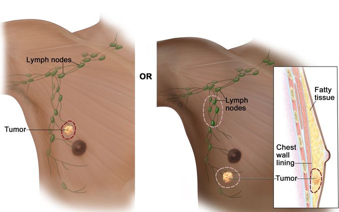 Symptoms of Breast cancer (male)