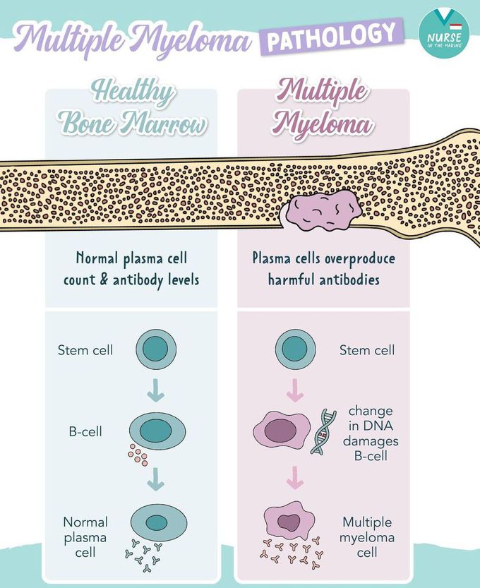 Multiple Myeloma