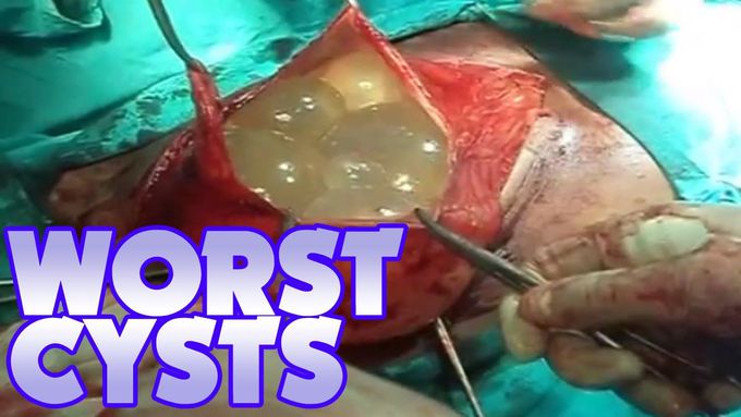 Worst Brain & Liver Cysts! Surgery Footage