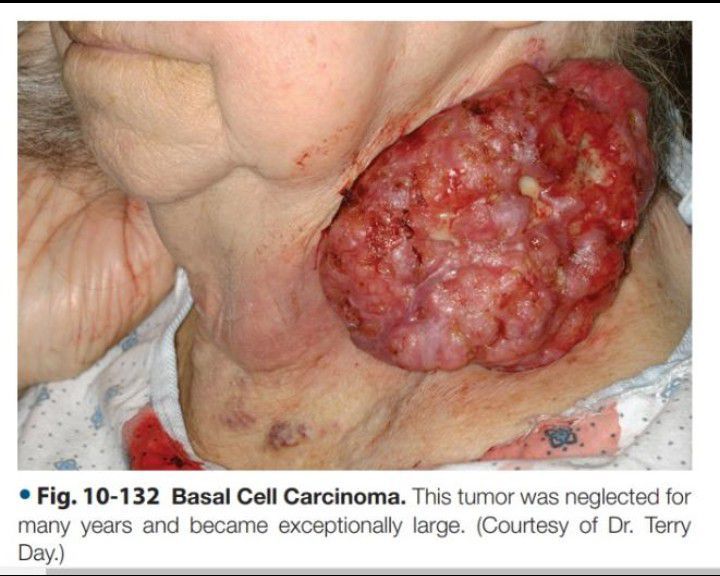 Basal cell carcinoma- neglected for a long time