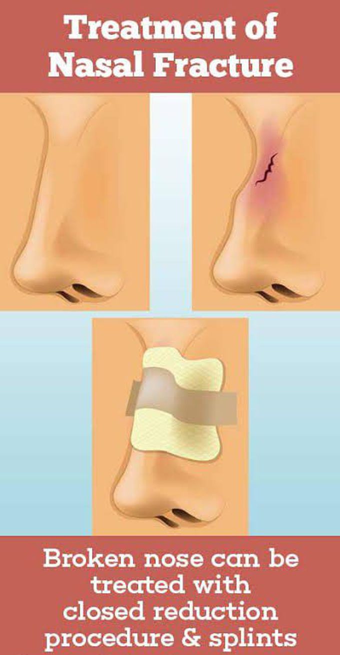 This is the treatment of a Nasal fracture