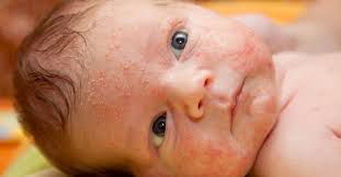 Symptoms of baby acne