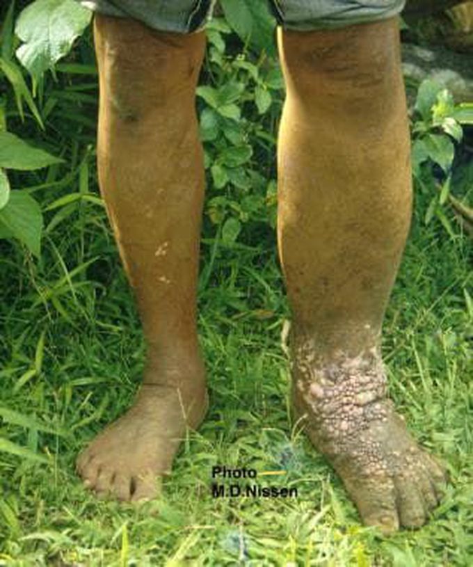 Filariasis