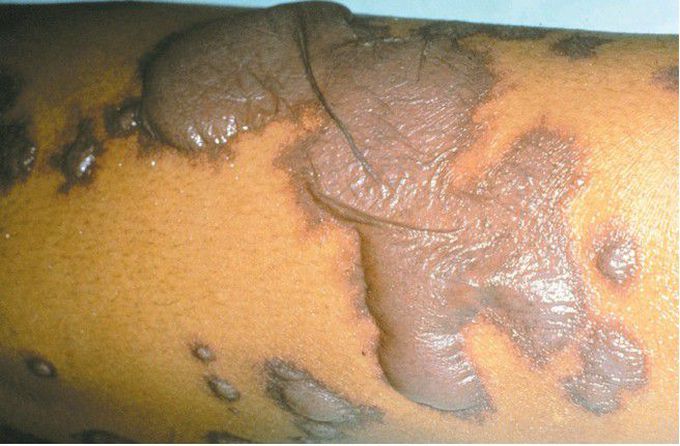 Toxic Epidermal Necrolysis.